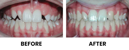 Missing Lateral Incisors